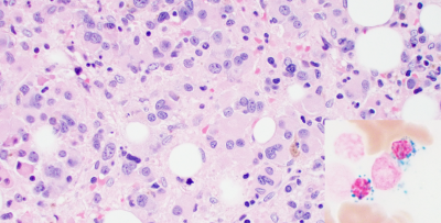 MDS with multi-lineage dysplasia and ringed sideroblasts.